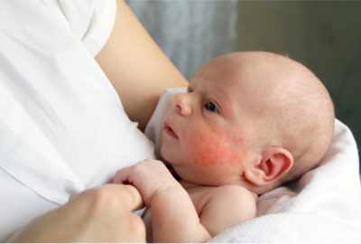 Infant-Eczema
